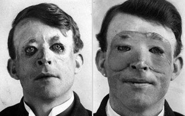 21.) Walter Yeo, one of the first people to undergo a skin transplant and advanced plastic surgery in 1917.