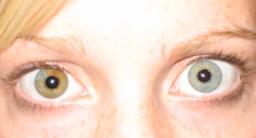 Pupula duplex may not be well documented (or real), but here are number of conditions that people do have. For example, heterochromia iridum, which causes separate coloration of the irises.