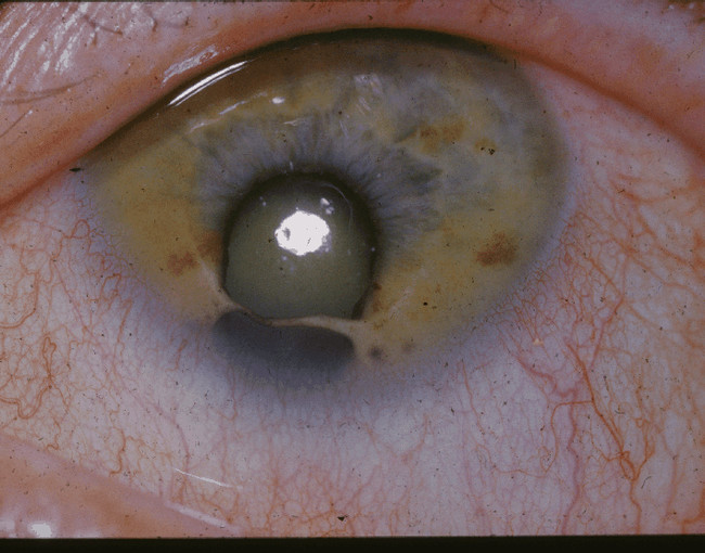 The horrifying coloboma is a birth defect that causes a hole in the iris. Most people who suffer from coloboma are also blind.