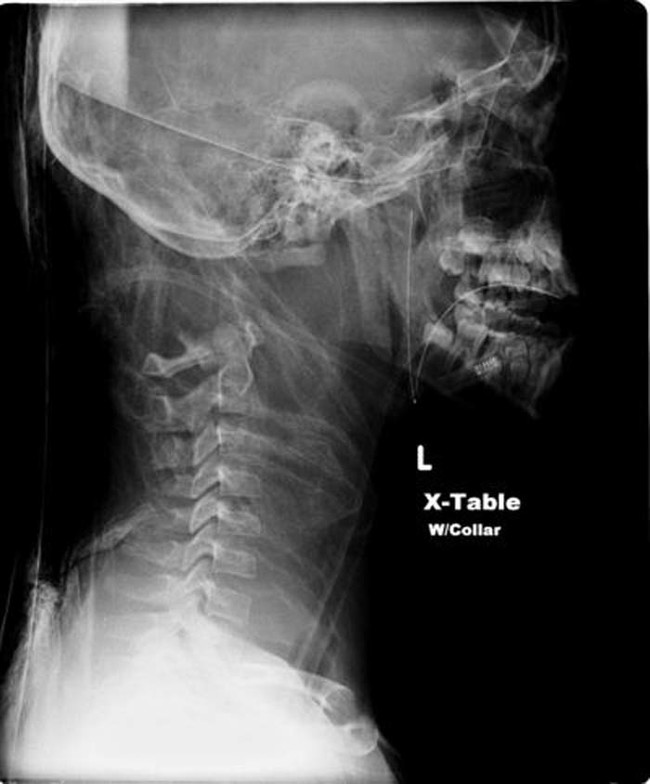 There are two types of decapitation: internal and external.