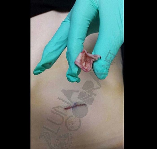 The procedure leaves just a small scar.