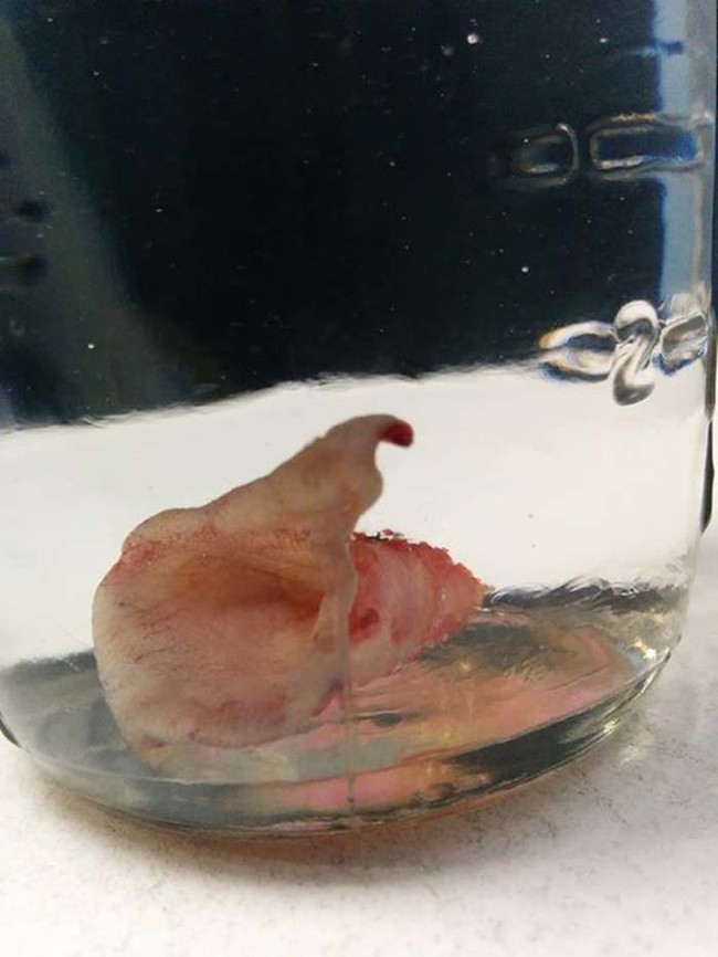 There it is. The removed belly button in all its glory.