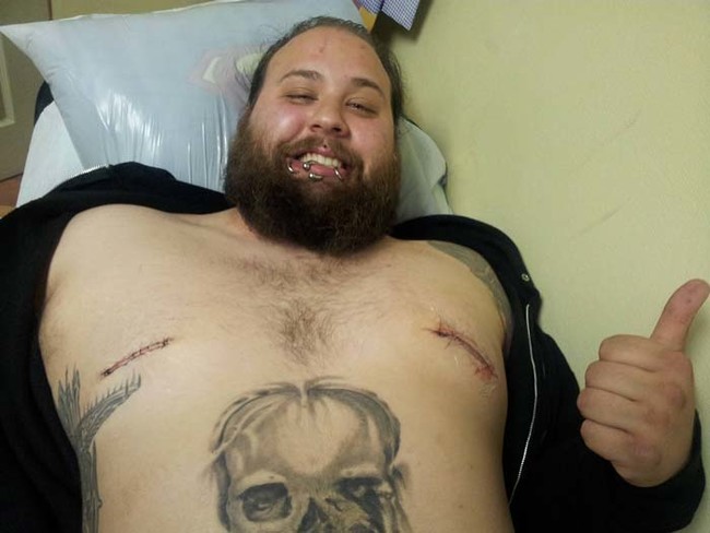 This man just had his nipples surgically removed.