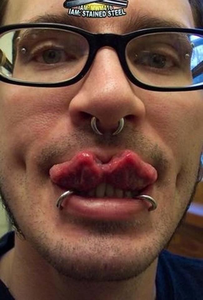 Here's what a bifurcated tongue looks like after it's healed.