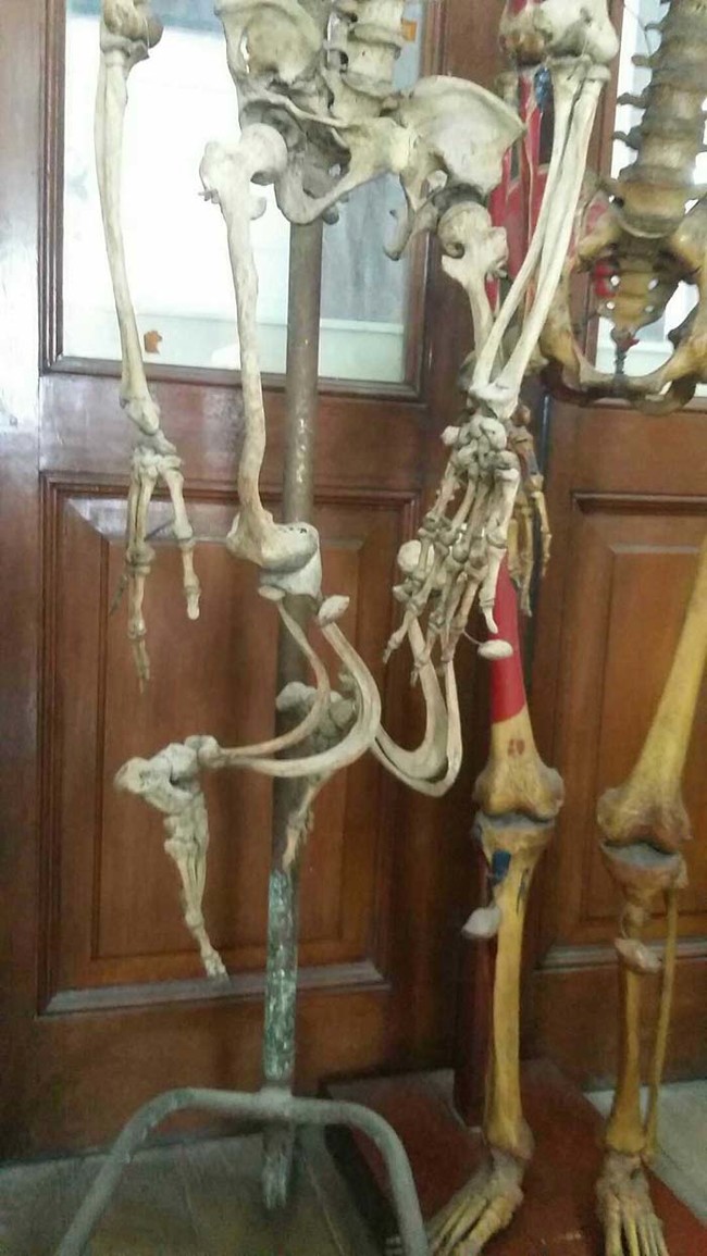 The result of a severe case of rickets. Because of a vitamin deficiency, the leg bones become weak and bend under the weight of the body.