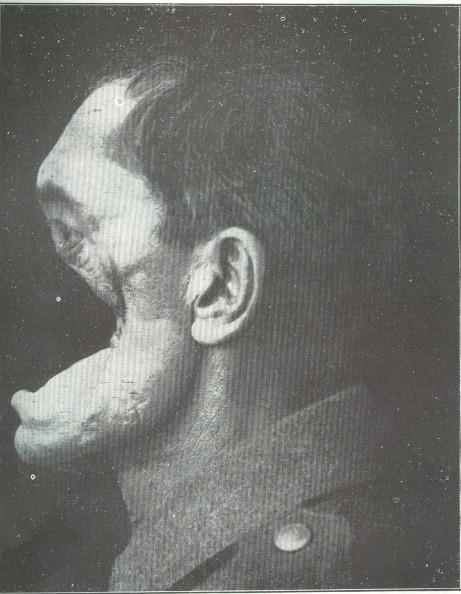 Horrifying (and nearly fatal) facial injuries to a German soldier in World War I.