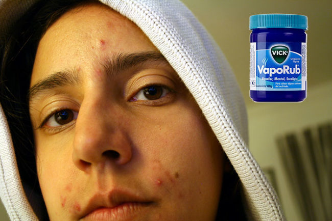 Put some Vicks on your acne trouble spots and sleep on it. After a few nights of doing this, your acne will disappear!