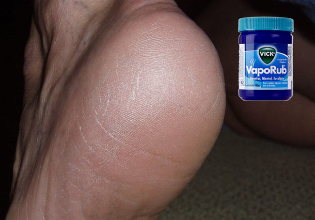 Feel the healing effects right away when you rub cracked heels and elbows with the ointment.