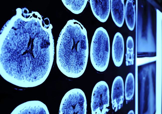 Richard Speck died of a heart attack in 1991. An autopsy revealed brain abnormalities that stunted memory and strong emotions, which experts believe contributed to his murderous tendencies.