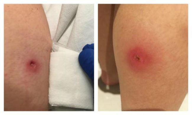 Doctors were baffled by the antibiotic-resistant bite when the Spilmans brought the little girl in for treatment.