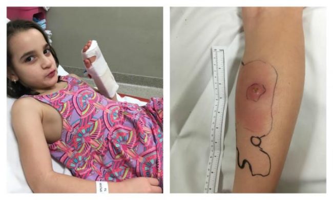 Mia spent more than three months in treatment and was administered eight rounds of antibiotics. Because it took so long to diagnose her, they may have to operate to remove the infection.