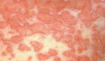 Harper was finally diagnosed with Eczema Herpeticum, a rare, life-threatening infection caused by the herpes simplex virus.It can cause blindness and organ failure if left untreated.Thankfully, Harper's vision hasn't been affected and she's doing better with the correct antiviral medication.