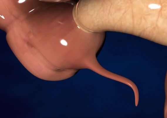 Your appendix could rupture at any time without a lot of warning, putting you at risk of dying from sepsis.