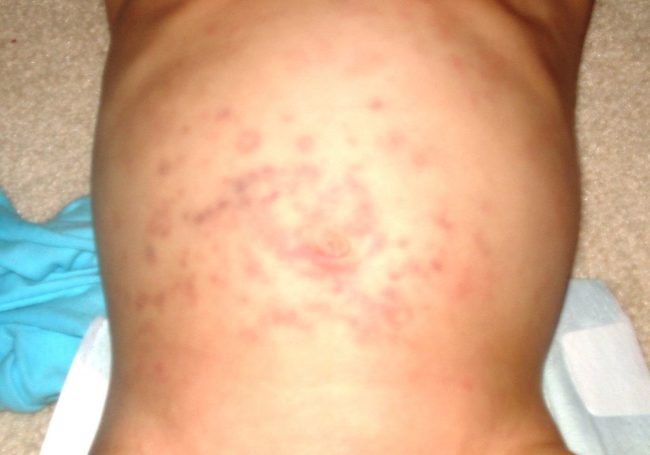 About 300 new cases of Stevens-Johnson syndrome are reported every year in the U.S.According to Mayo Clinic, it starts with flu-like symptoms and is followed by a painful red or purple rash that spreads and blisters before the top layer of skin dies and sheds.