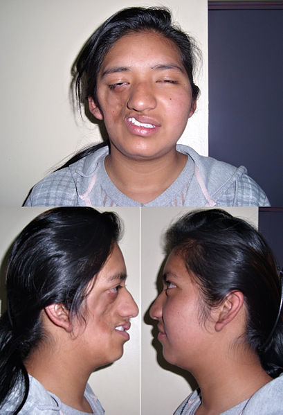Parry-Romberg syndrome literally causes one side of your face to cave in from shrinking and degenerating tissue beneath the skin.It can't be reversed, but surgery can help restore a more normal appearance.