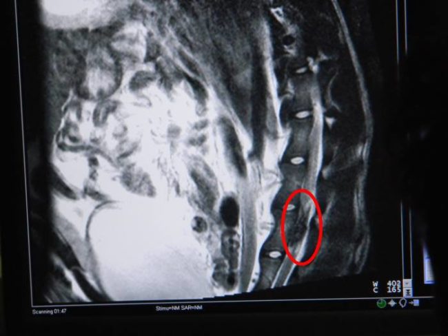 Veterinarian Marin Velickovski took the bullet out of his back. It was then that Zhile began the journey to health and happiness, but sadly, it became clear that he'd never walk without a rear-leg wheelchair again.