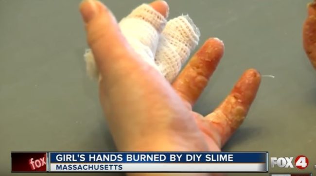 Kathleen's mom took a closer look and was shocked by what she saw. The family rushed to the hospital, where doctors informed them that she'd suffered third-degree burns.