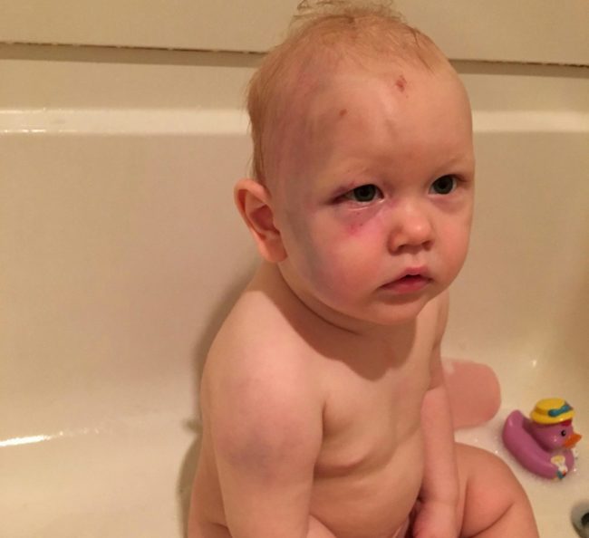 Doctors evaluated Jacob&rsquo;s condition and social workers took pictures to document the obvious signs of abuse. They even found a handprint-shaped mark on the poor baby's face.