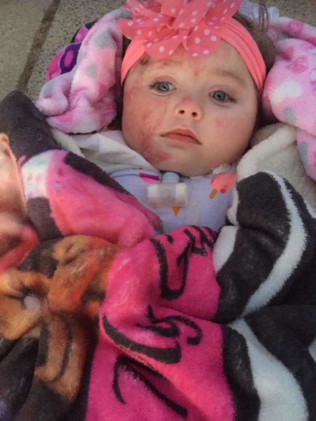 Doctors believed she wouldn't survive, but she made it through multiple skin graft surgeries, had a tracheostomy to help her breathe, and got a feeding tube. Though it looks like she's now awake, her current condition isn't clear.