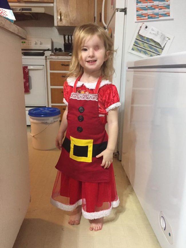 In addition to going through weeks of radiation, Brynn had the tumor removed twice, then a third time when it grew back. They ended up having to remove her left eye and place a skin graft over the area, but this cutie's now in remission.