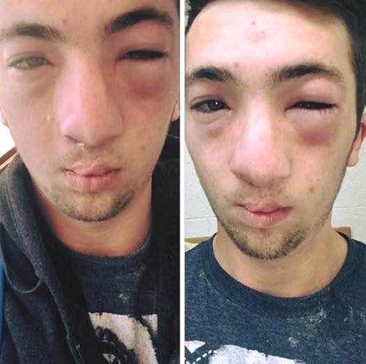 Andrew Seely suffered an allergic reaction following the hazing incident and dealt with swollen eyes and lips.