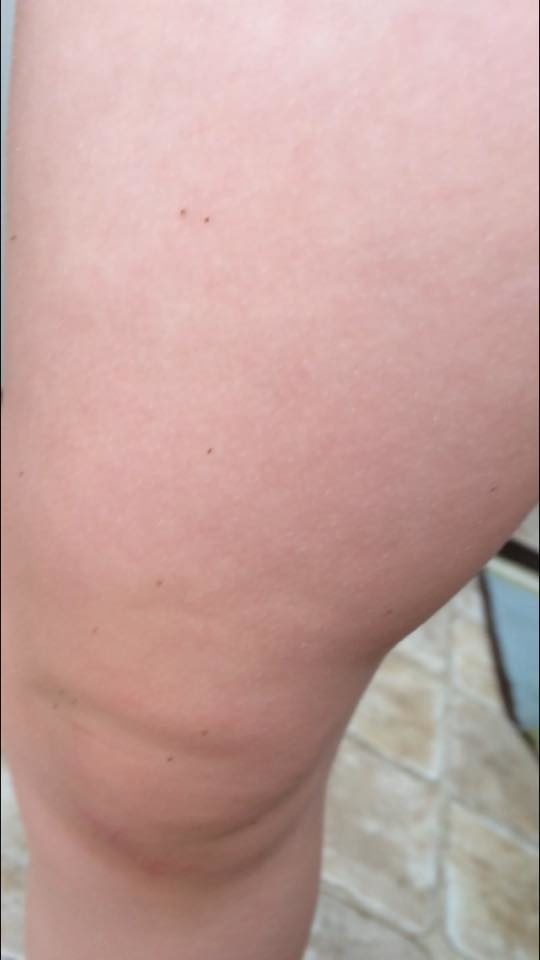 Beka Setzer and her three-year-old daughter Emmalee were playing in the yard when the concerned mom noticed what she thought to be specks of dirt covering her daughter’s knees.