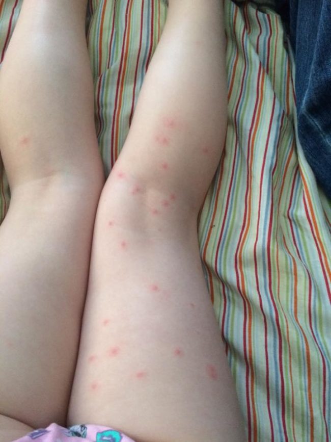 When Setzer’s daughter awoke the next day, she was covered in tiny red welts.