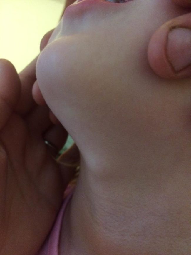 Thankfully Emmalee tested negative for Lyme disease, but as a result of the tick bites, a large cyst on her lymph nodes had to be surgically removed.