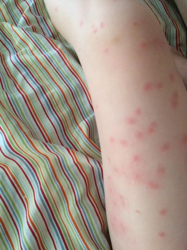 Emmalee’s lymph nodes were severely swollen, which sent Mom rushing to the hospital with her little one.