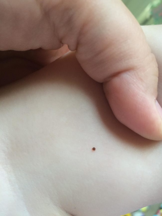 Upon closer inspection, Setzer discovered the spots were in fact tiny seed ticks that had attached themselves to the young girl’s knees.