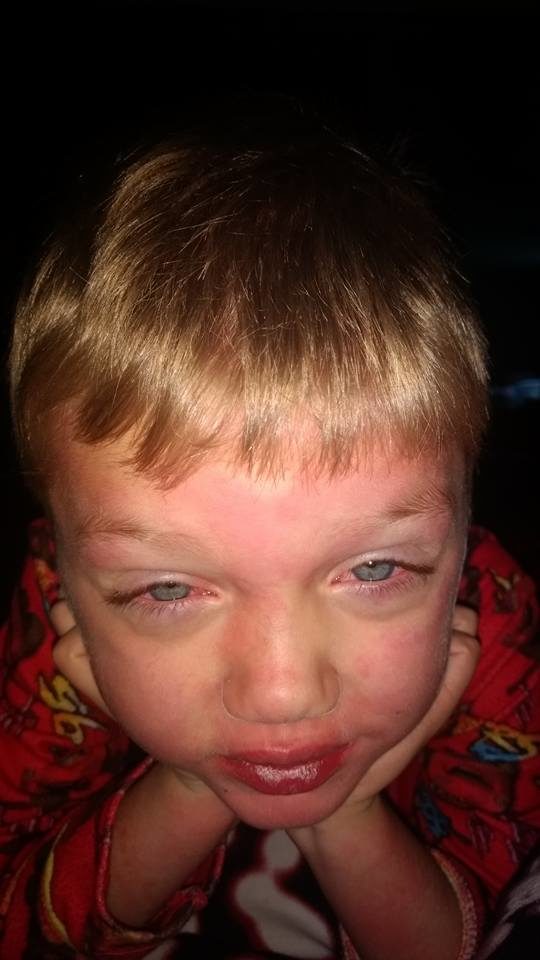 The next day, he wasn't eating or drinking anything at all, and his eyes were bloodshot. Natasha took him to the hospital, where he was put in quarantine for a possible case of the measles. However, the doctor who examined him said it wasn't measles and likely just a virus, as Oliver was up to date on all his vaccinations, including two measles shots. They were sent home.