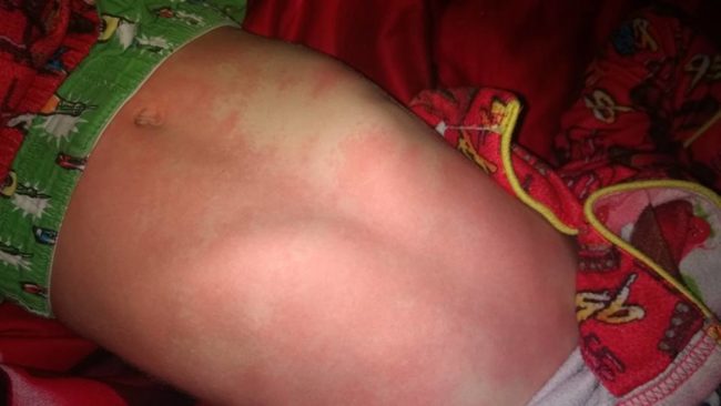 By Tuesday, he was in so much pain that he couldn't even get out of bed and said he felt like he was dying. Nastasha says he was "covered from head to toe in the worst rash I have ever seen, his fever (with Tylenol and benadryl) was past 40&deg;C and his lips were so swollen that they were cracked and bleeding." She took him to a different hospital where she was told the same thing.