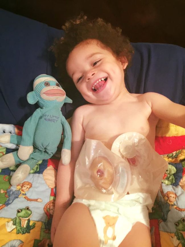 At just two weeks old, the brave little guy's colon ruptured, leaving him with no other option for survival than to live the rest of his life using stomas and colostomy bags.
