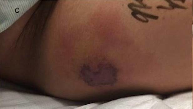 Three days after his swim, he was admitted to a Dallas hospital with severe pain in both his legs and his arms. He had chills, a fever, and the area around the tattoo was obviously infected.