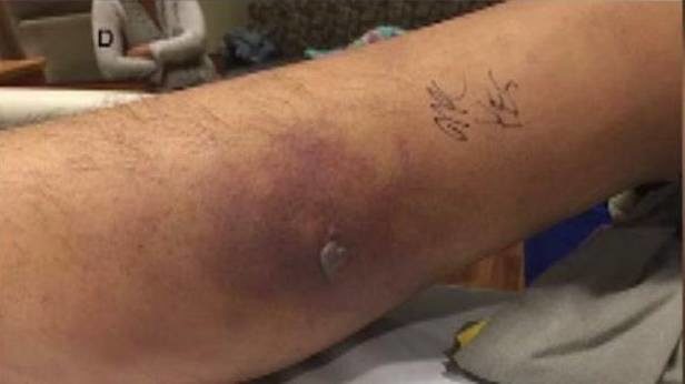 He also tested positive for vibrio vulnificus.