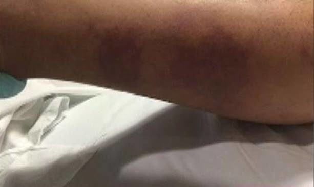 Within just a few hours, the man began experiencing darkening skin, bruising, and large amounts of fluid building up inside his legs. He was in the early stages of septic shock.