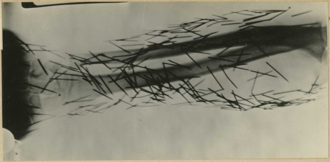 This historical medical image shows self-mutilation using graphophone needles.