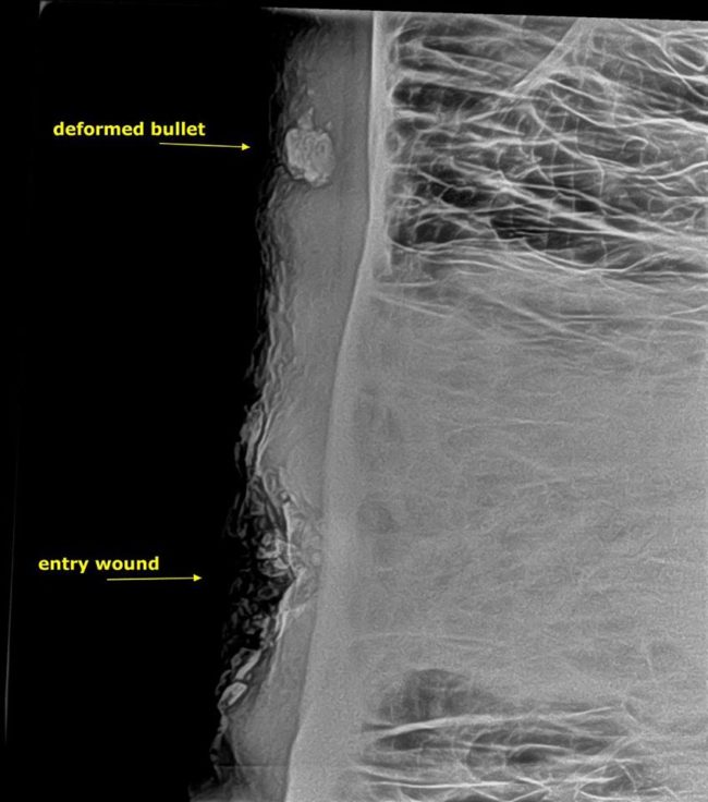 They performed an x-ray on his skull and found that a deformed bullet had fractured his sinuses, which was causing the pus.
