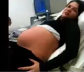 Even though Arthur is injured, doctors say his survival is miraculous and that treatment may be possible as he grows. "Today, he is paraplegic, but anything can happen in the life of this child," said Dr. Jos&eacute; Carlos Oliveira, who is now monitoring Arthur&rsquo;s progress.