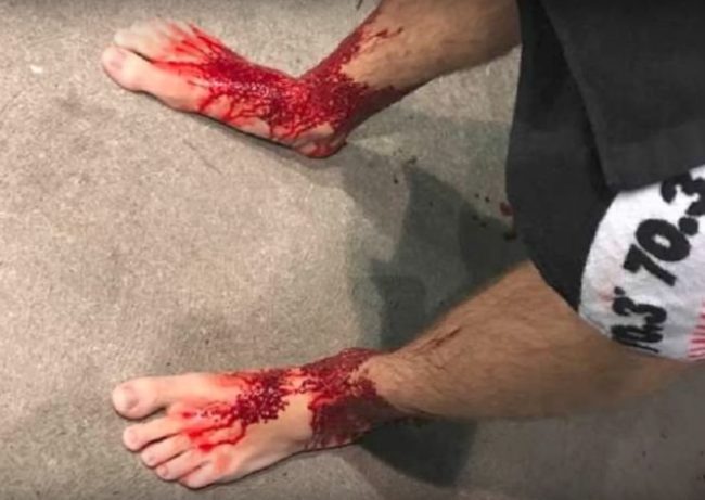 At first, he thought he had slipped on a rock, but then he noticed holes in his ankles. The rush of blood just got worse, and he was rushed to the hospital.