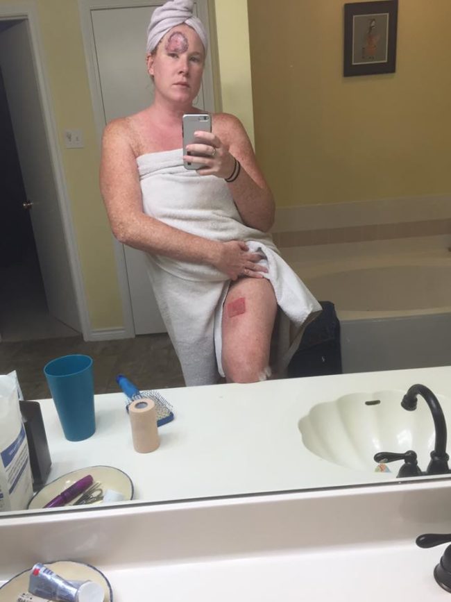 She began calling her skin graft "bacon," which had been taken from her upper thigh.
