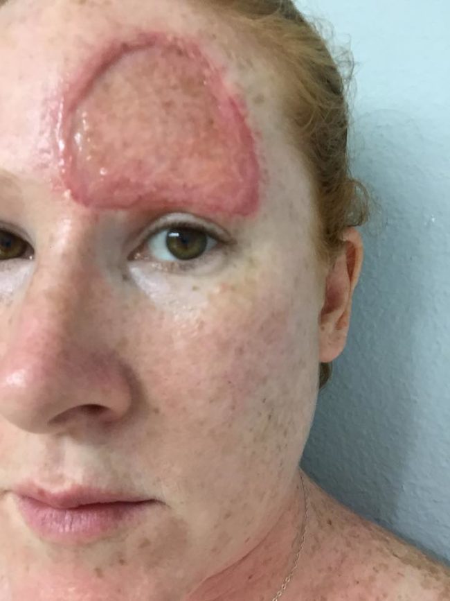 As her newly grafted skin healed, she unfortunately got more bad news. The cancer had spread to her bones and lymph nodes, and she had to start immunotherapy in October 2016.