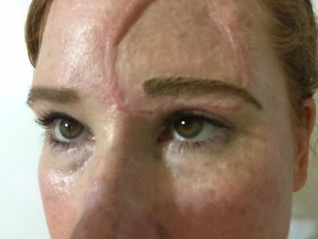 Now she's done with treatment and in the clear, but she's sharing her journey to warn others about the dangers of the sun and tanning beds.