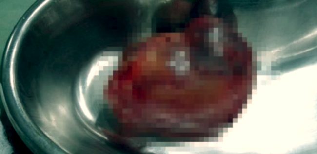 One theory about the condition is that the abnormal mass is a highly developed teratoma. The other is that with twins, one fetus becomes enveloped by the other. According to gynecologist Dr. Neena Nichlani, this was the case with the baby boy from India. 