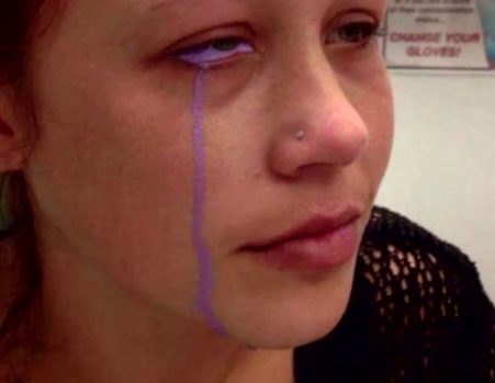 Her eye had an infection and was leaking ink. She's saying that "undiluted ink, over injection, and not enough/smaller injections [sites]" caused it.