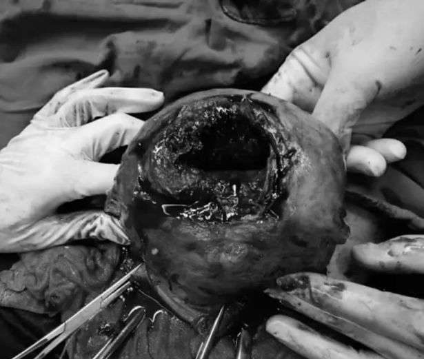 Such a break is known as a rupture pregnancy and impacts less than 5 out of every 1,000 pregnancy women who have had previous Cesarian work.