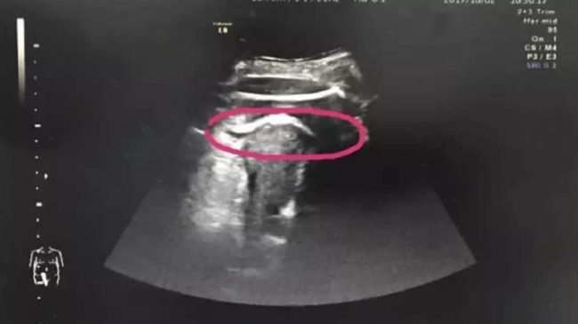 In a matter of minutes, Zhang was rushed to an operating table, where doctors discovered that the unborn fetus&rsquo; legs were poking into her abdominal cavity.