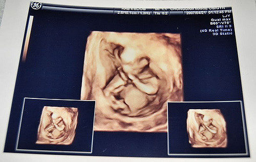 The woman, only identified as Zhang, was in her 35th week of pregnancy when she was rushed to the hospital after experiencing abdominal pain, as well as problems with her blood pressure, breathing, and pulse.