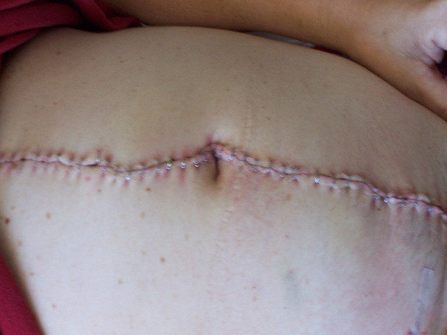 According to doctors, the woman&rsquo;s previous surgeries had left her with severe scar tissue that left the uterus wall more at risk of breaking.