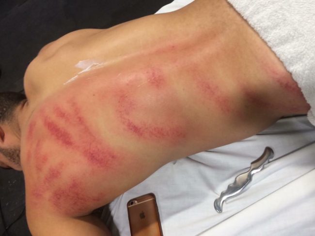 The angry, red marks you see on the people pictured aren't the results of damage to posture -- rather, they're the visible effects of gua sha, a healing technique of traditional East Asian medicine which involves "scraping" the skin with a massage tool.